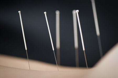 acupuncture-common-questions